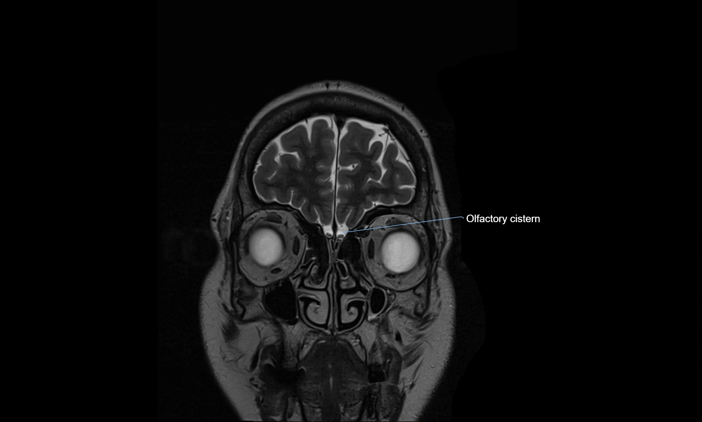 Brain cisterns  and ventricles coronal anatomy 3T MRI image-img-00001-00003.webp